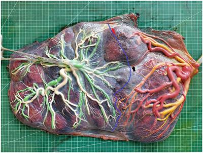 Thick artery–artery anastomoses delay the onset of selective fetal growth restriction in monochorionic diamniotic twins: a 7-year single-center cohort study